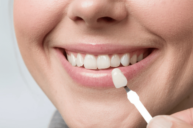 Dental-Veneers