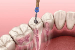root-canal