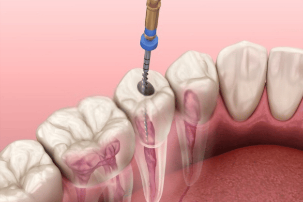 root-canal