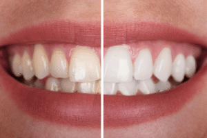 teeth-whitening