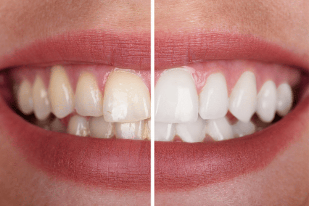 teeth-whitening