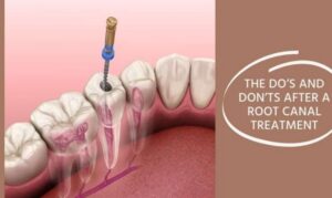 After care of Root Canal Treatment