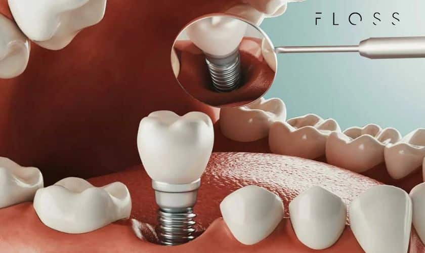 Dental-implant