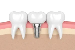 How Dental Implants Can Improve Your Quality of Life