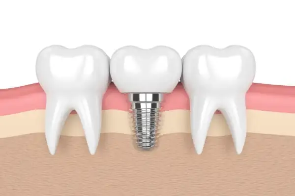 How Dental Implants Can Improve Your Quality of Life