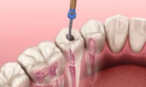 Root Canal