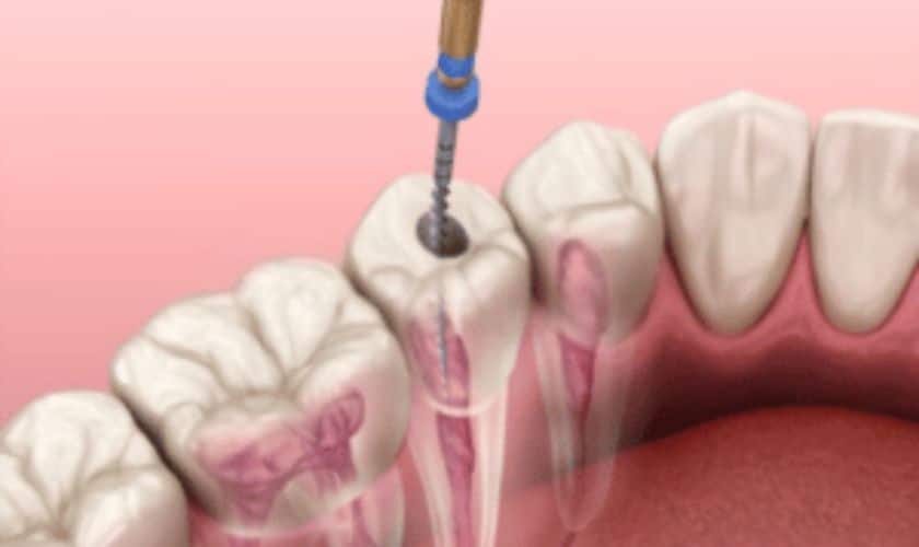 Root Canal