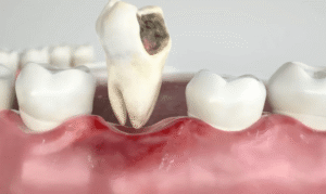 Is Tooth Extraction A Better Option For A Large Decay On A Tooth