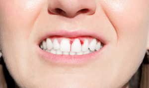 What Does It Mean If Your Gums Randomly Bleeding