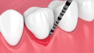 Gum Graft Recovery: Week-by-Week Healing Timeline