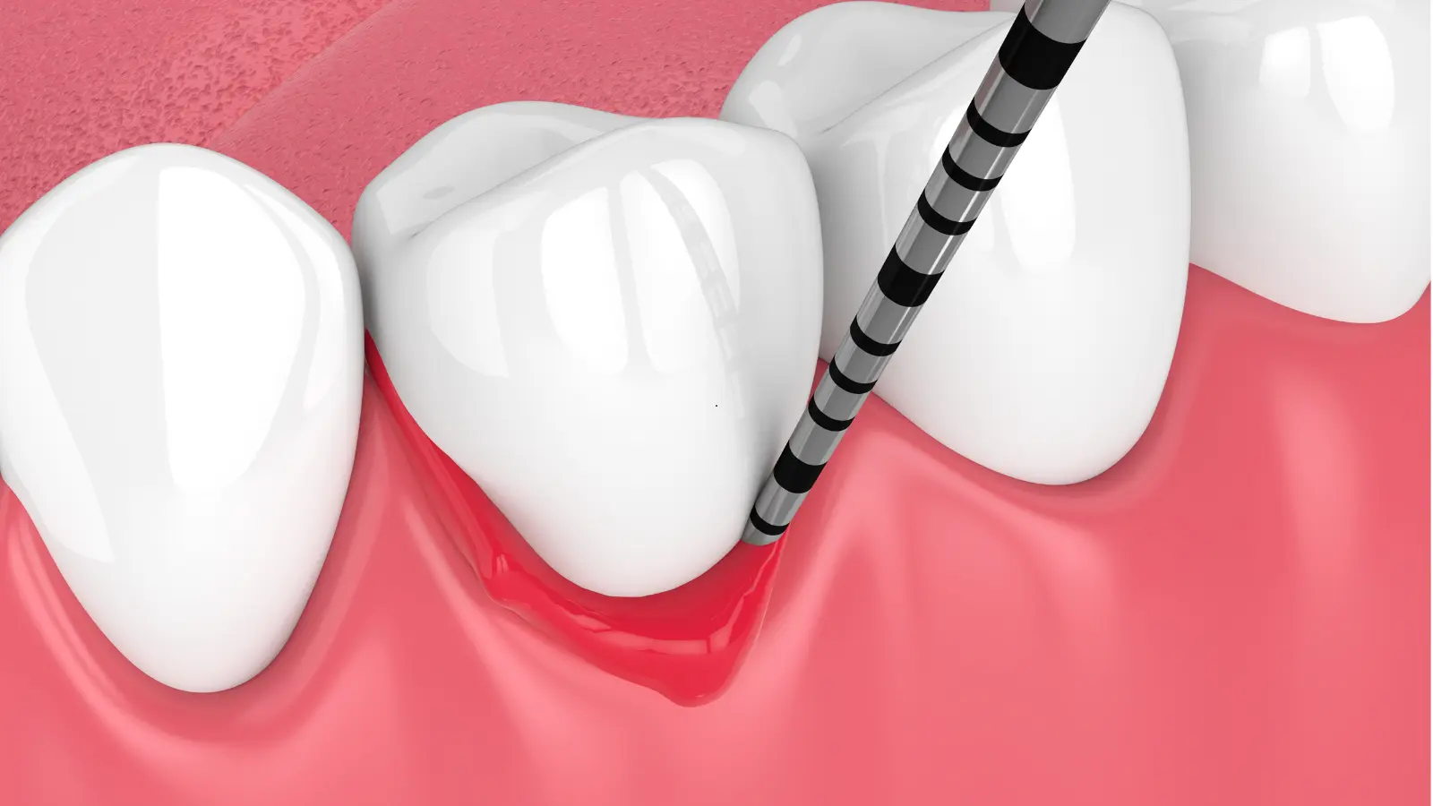 Gum Graft Recovery: Week-by-Week Healing Timeline