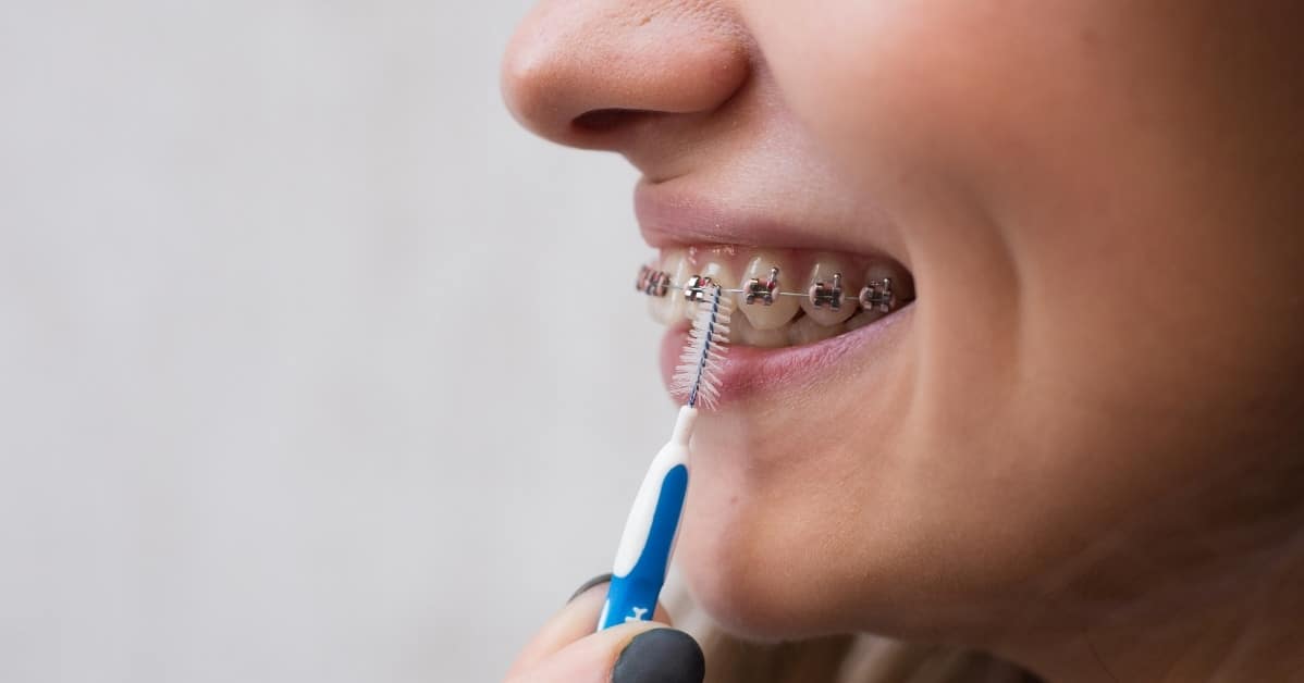 whitening teeth with braces