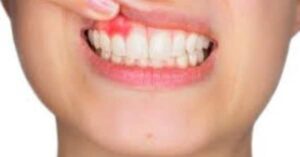 what is periodontitis