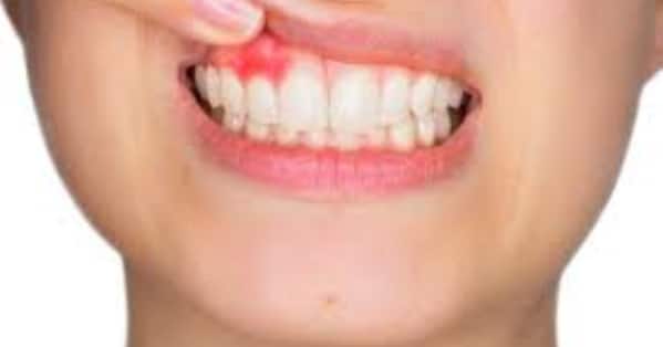 what is periodontitis