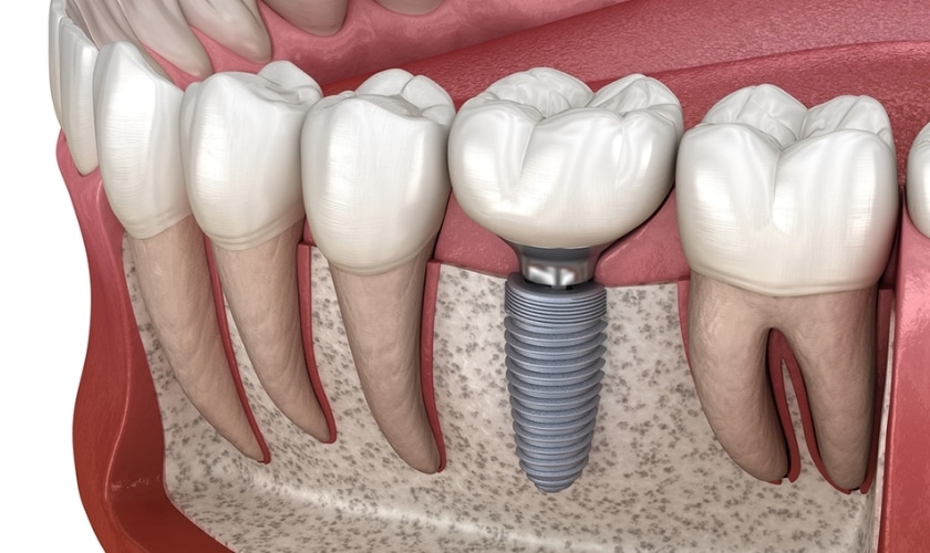 Illustration of a dental implant replacing a single tooth